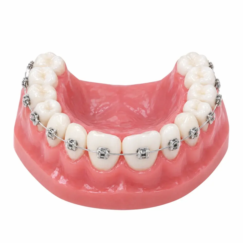 3D model of an upper arch with metal braces